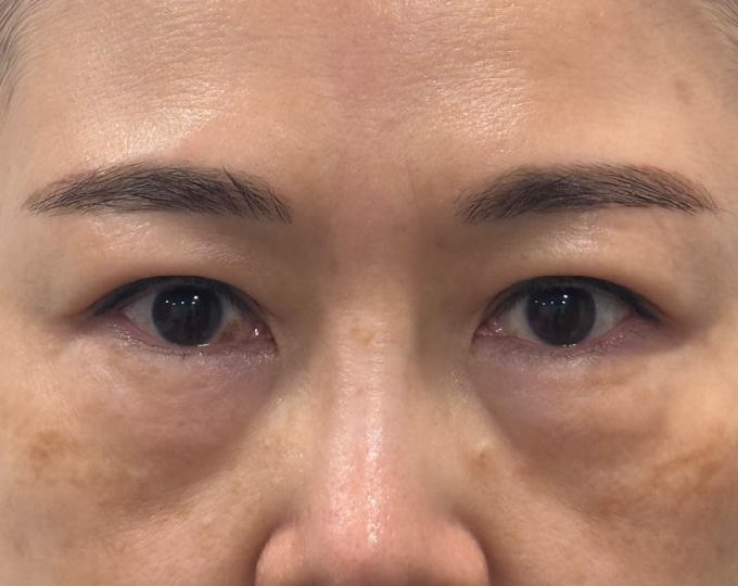 Before
