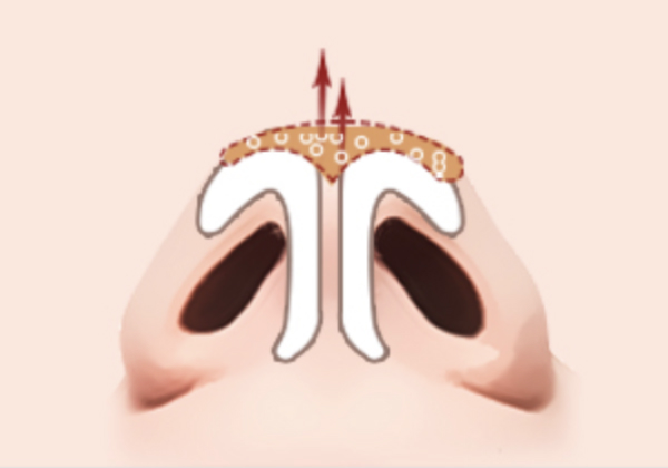코 끝 지방 제거