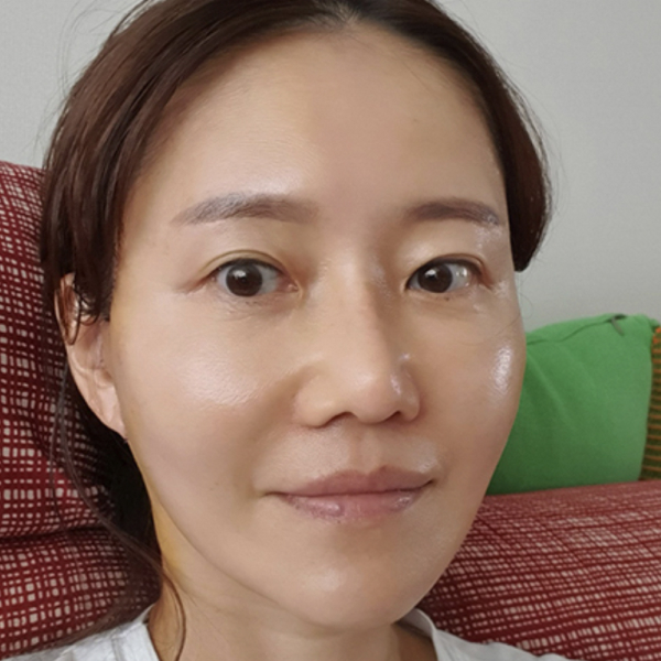 광대뼈수술 과정 4