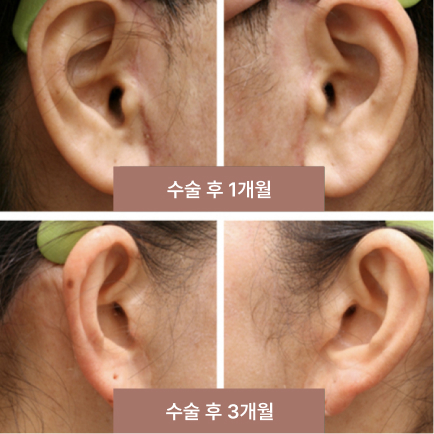 광대뼈수술 과정 4