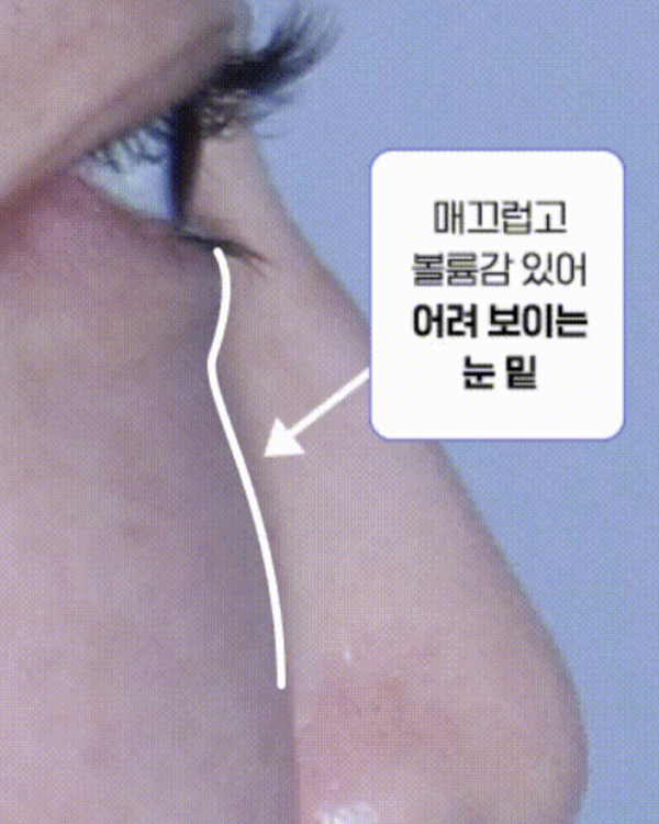 수술 후 눈밑