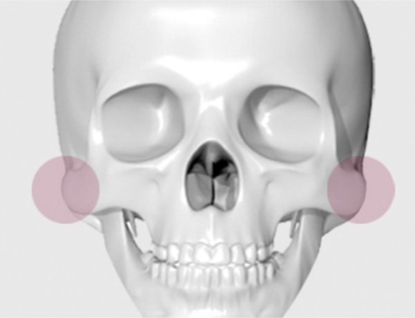 광대뼈수술 방법 2