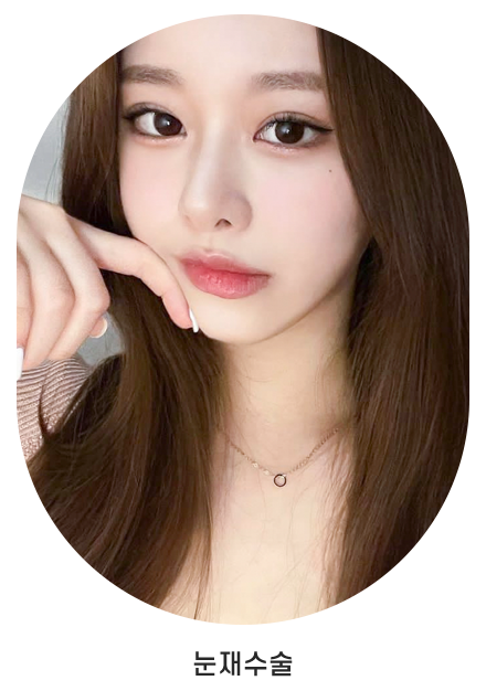 눈재수술